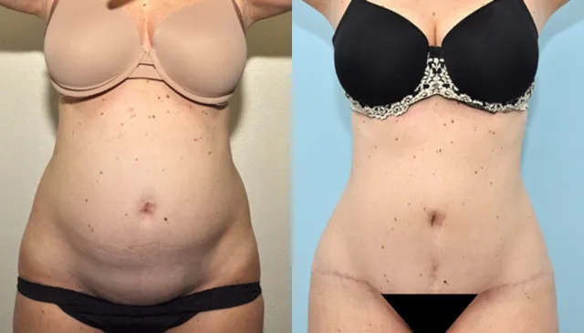 Before and after photo of a tummy tuck patient of Dr. Zapiach in Paramus, NJ