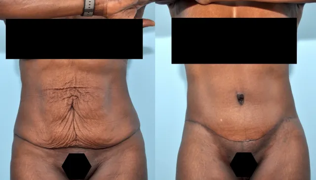 Before and after tummy tuck results by Dr. Luis Zapiach in Paramus, NJ