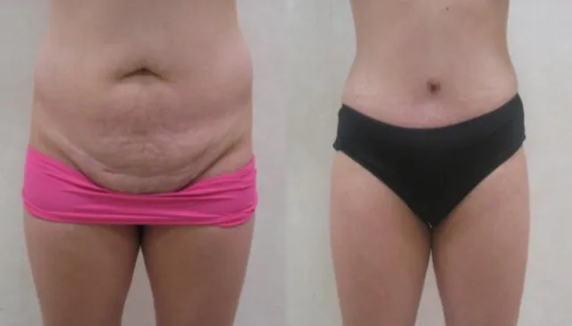 Tummy tuck before and after by Dr. Luis Zapiach, Art Plastic Surgery in Paramus, NJ