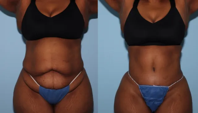 Before and after photo of a tummy tuck patient of Dr. Zapiach